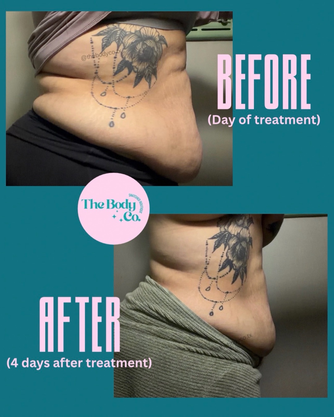 Ultrasonic Fat Elimination & Skin Tightening