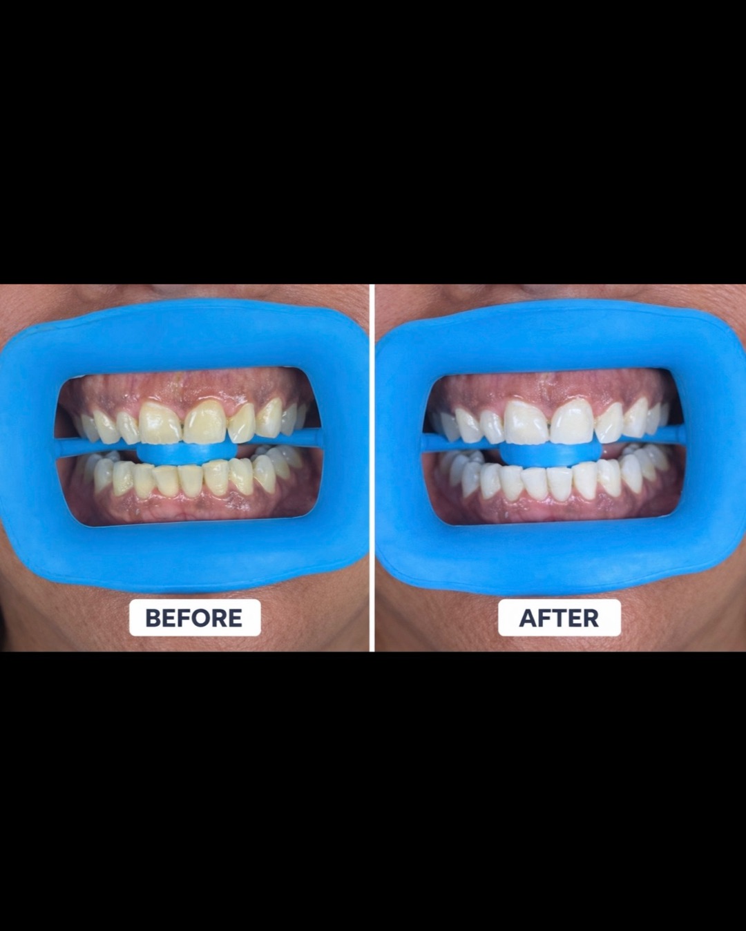 Teeth Whitening with Kyndra 