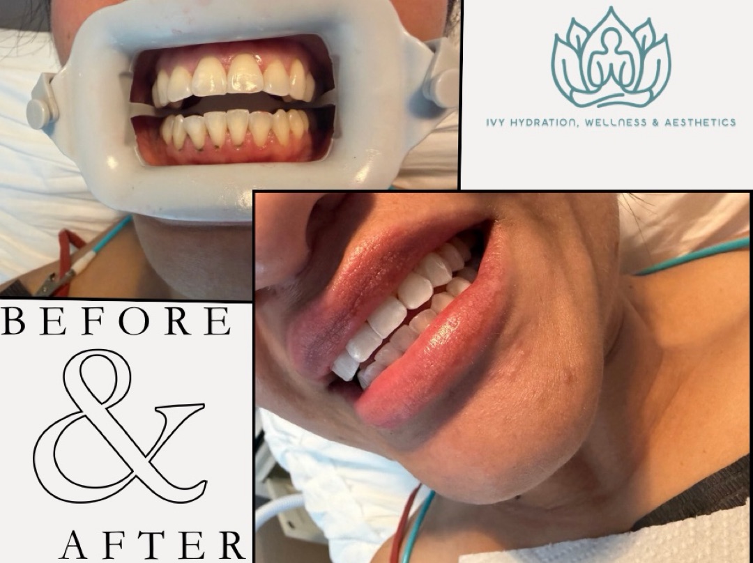 Teeth Whitening 