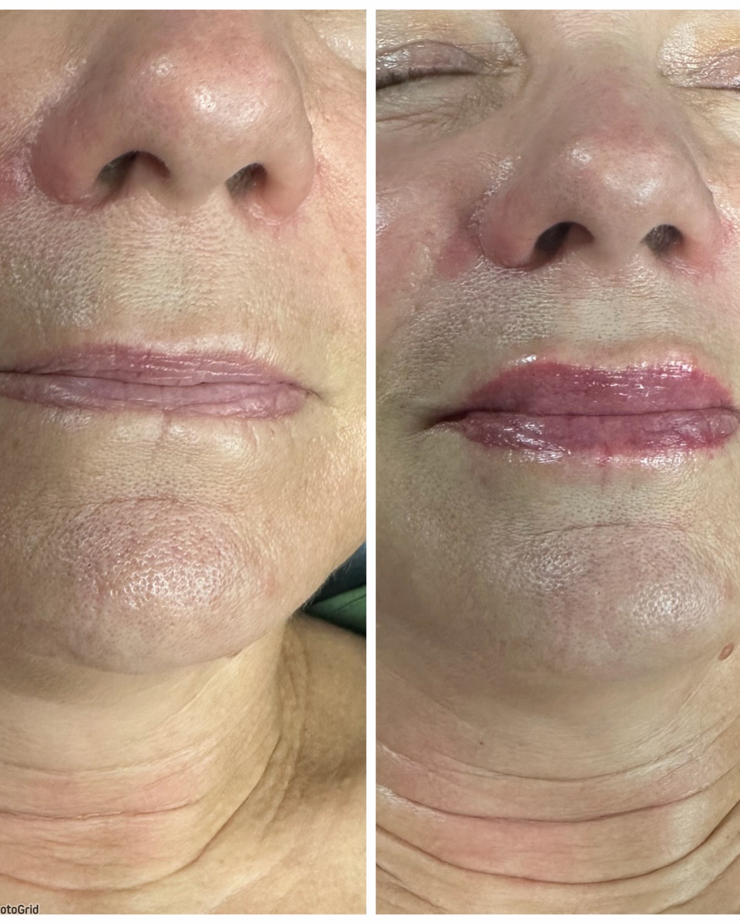 Full syringe lip filler 