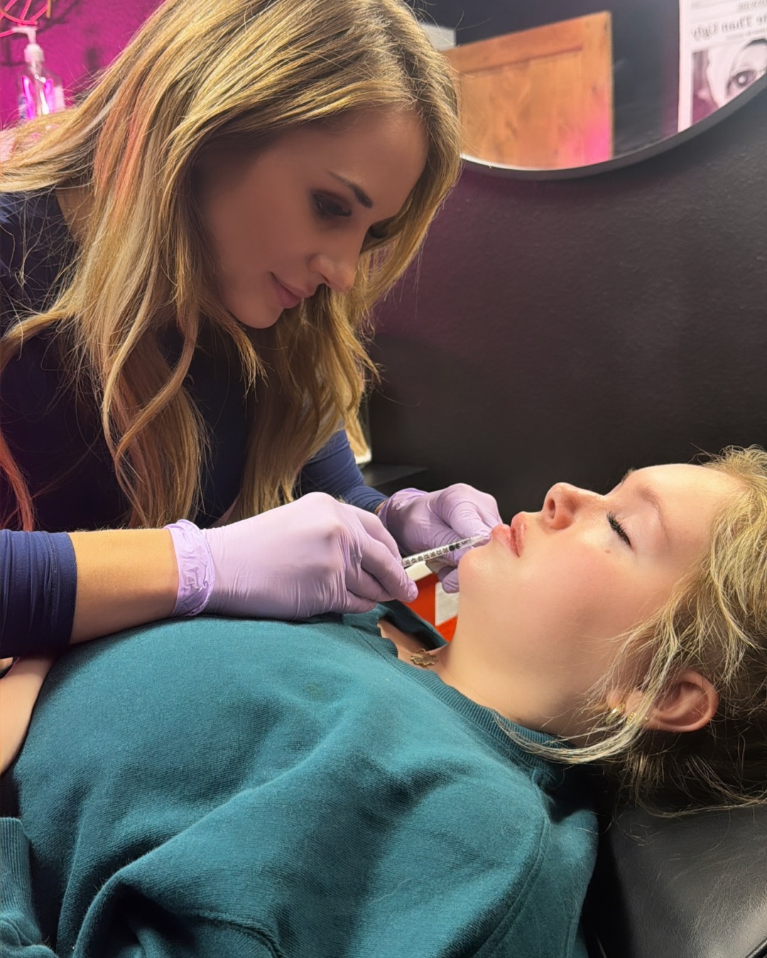 Lip Filler